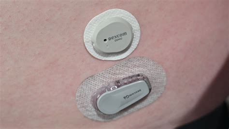 dexcom.
